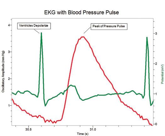 EKG with Blood Pressure Pulse